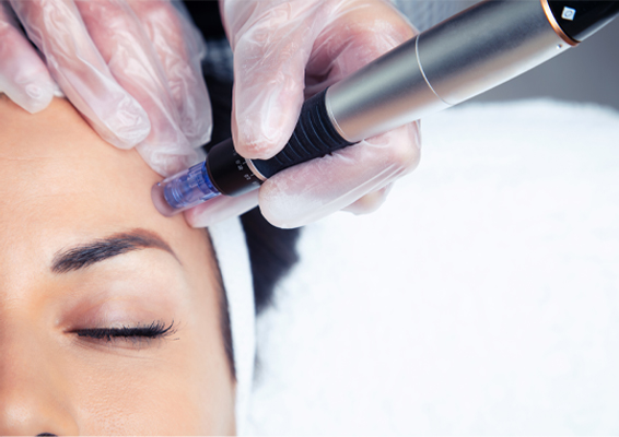 Morpheus8-for-Skin-Clinic A woman gets a radiofrequency microneedling procedure. Get Morpheus8 radiofrequency microneedling treatment from Tanya Zboril, NP of TBT Medical in Kitchener-Waterloo.