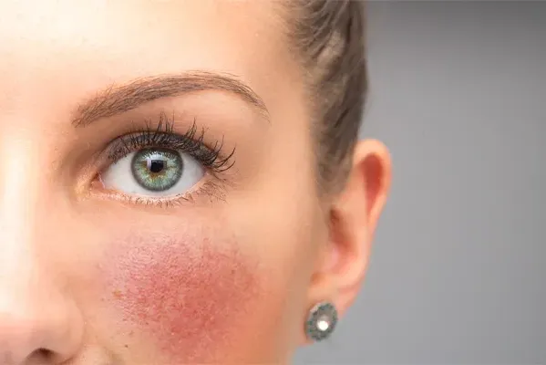 Rosacea-Doctor Close-up of a woman with rosacea on her cheeks. Schedule treatment for rosacea from Tanya Zboril, NP of TBT Medical in Kitchener-Waterloo.