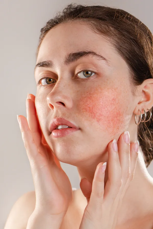 Rosacea-Treatment A women framing her face with her hands while inspecting her Rosacea. Receive IPL and Laser Treatment for Rosacea by Tanya Zboril, NP of TBT Medical in Kitchener-Waterloo.