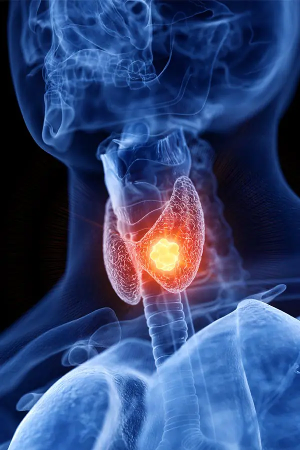 Thyroid-Imbalance-Treatment A 3D illustration of an x-ray of a human neck, highlighting the thyroid. Get help with thyroid imbalance from Tanya Zboril, NP of TBT Medical in Kitchener-Waterloo.